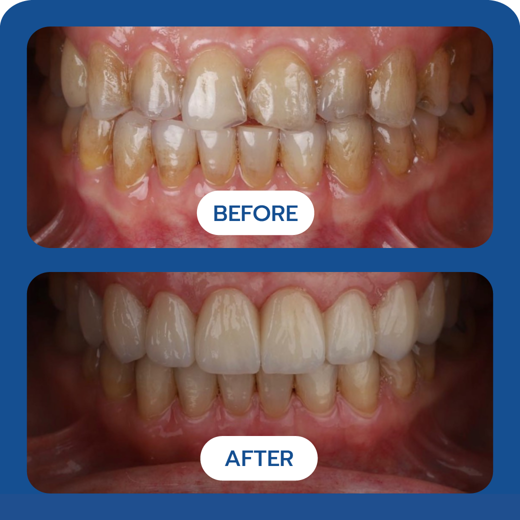 Before and After Case 4